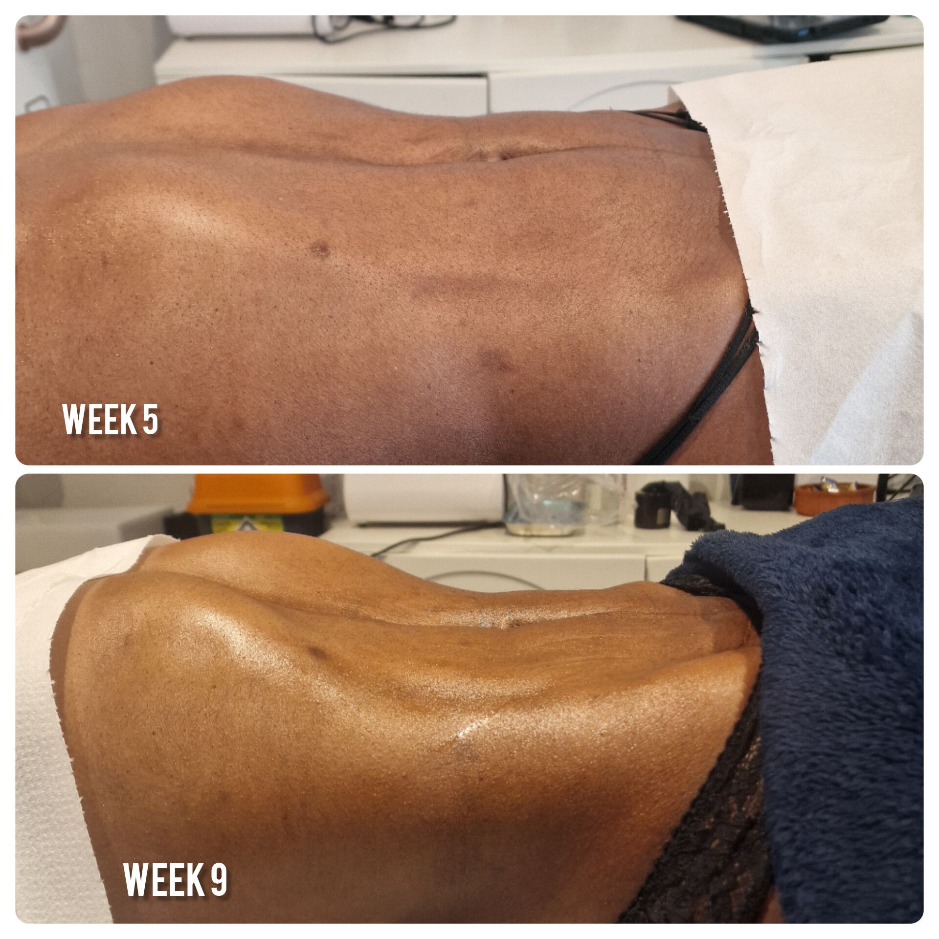 Post MLD treatment
Bodylanguage HB image