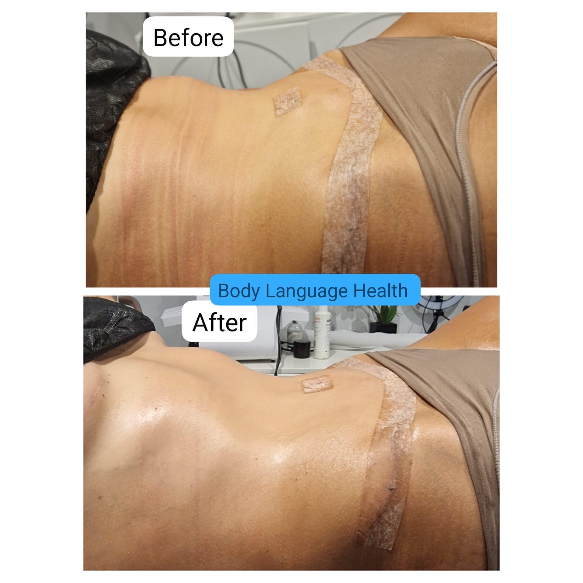 Ultrasonic cavitation and RF Frequency