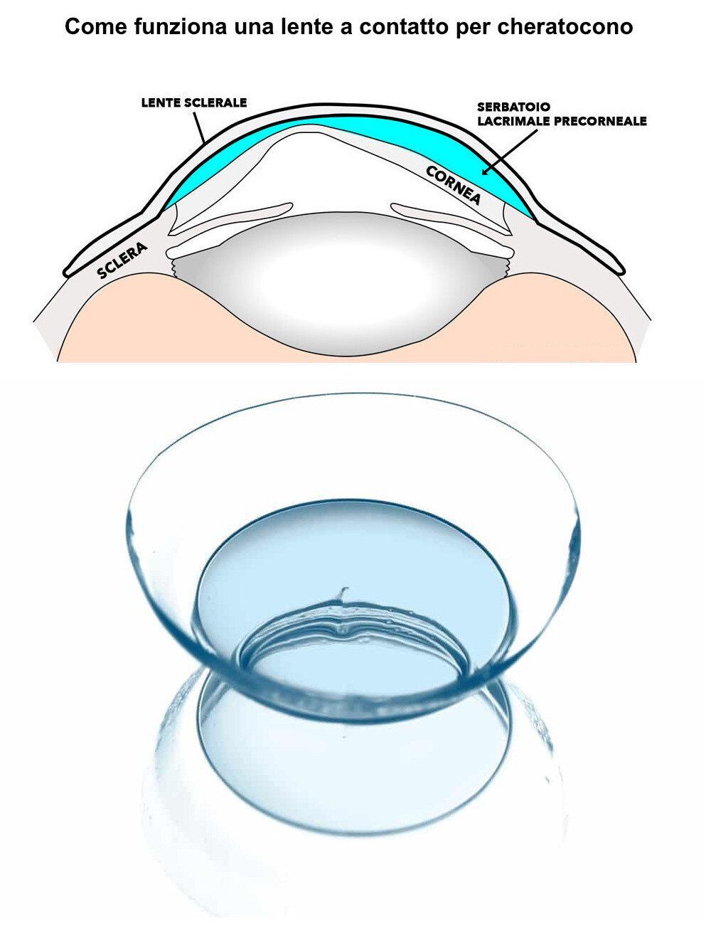 Lenti a contatto per cheratocono: Ottica Lente Amica a Rimini