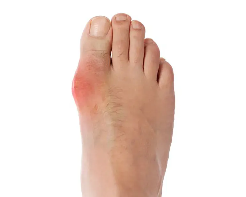 Gout — Acacia Podiatry in Parap, NT Gout — Acacia Podiatry in Parap, NT