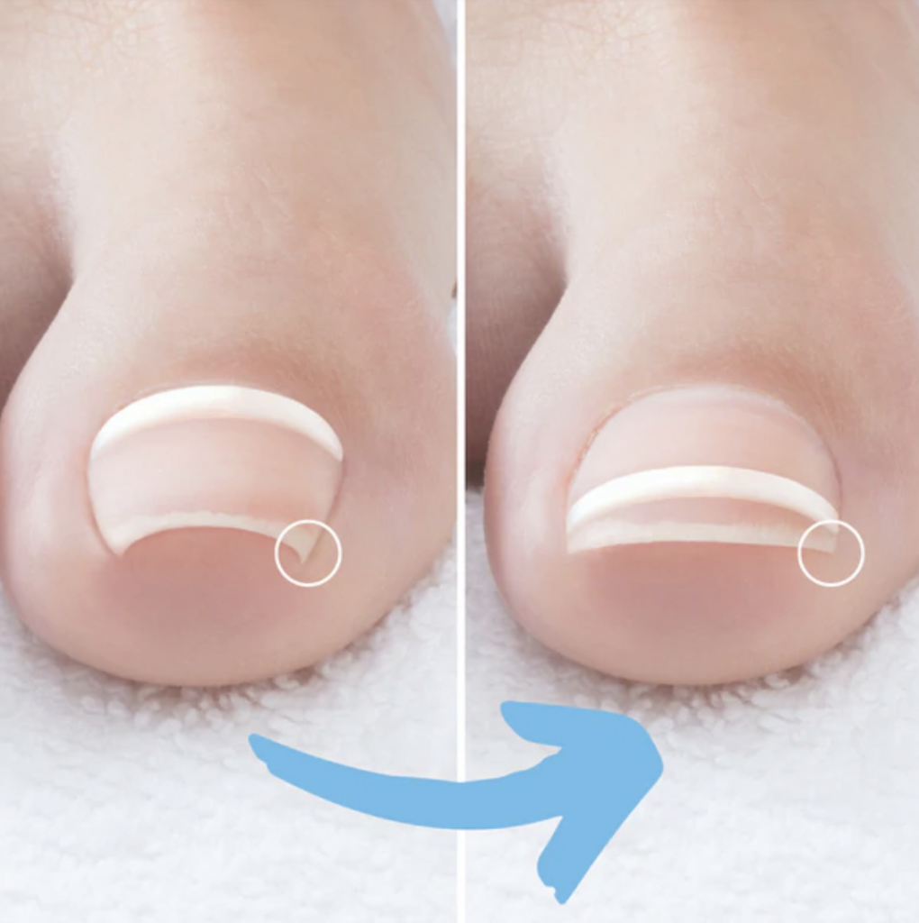 Orthotic Prescription — Acacia Podiatry in Parap, NT Orthotic Prescription — Acacia Podiatry in Parap, NT