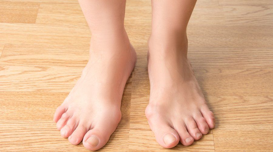 Juvenile Bunions — Acacia Podiatry in Parap, NT Juvenile Bunions — Acacia Podiatry in Parap, NT