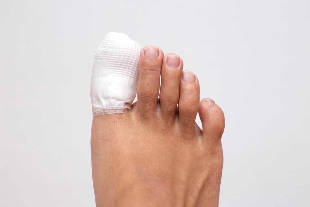 Treating Ingrown Nail - Acacia Podiatry in Darwin, NT