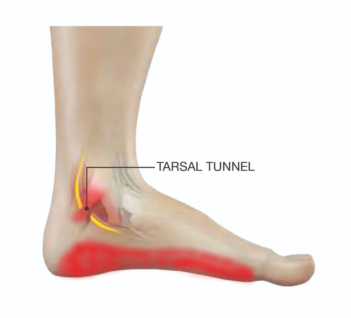 Foot Pain - Acacia Podiatry in Casuarina, NT Foot ankle Pain - Acacia Podiatry in Palmerston, NT