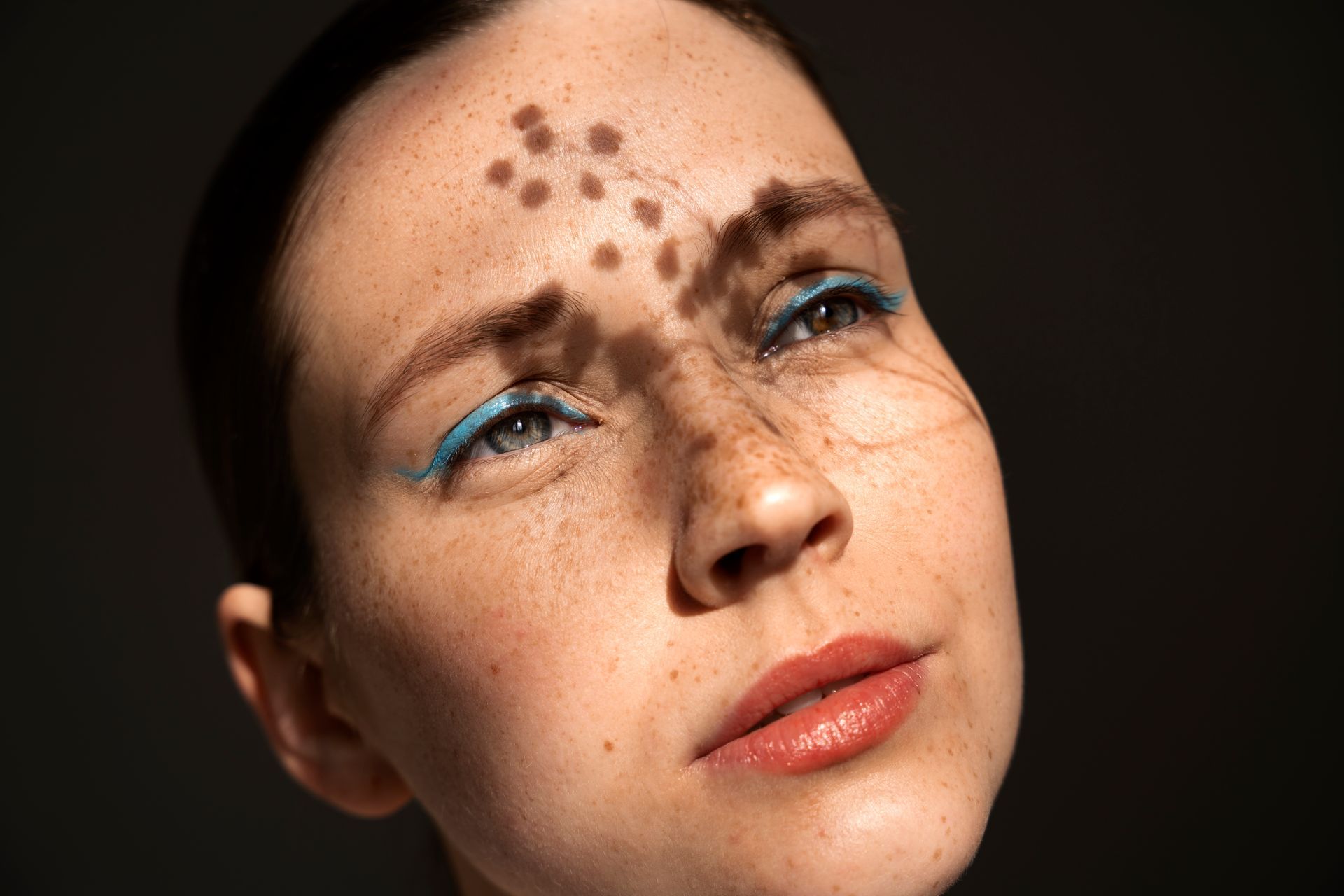 Melasma é inflamação crônica da pele