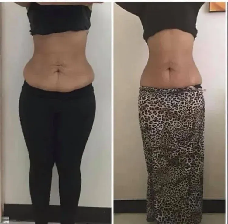 Before and after comparison of a woman's abdomen. Left side: wearing black; Right side: wearing leopard print skirt.