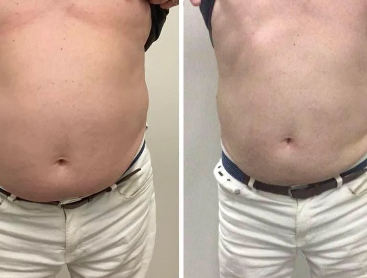 A before-and-after view of a person's abdomen. The after shows a reduction in belly fat.