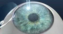 Primo piano di un occhio blu-verde sotto una lente a contatto trasparente con un riflesso luminoso