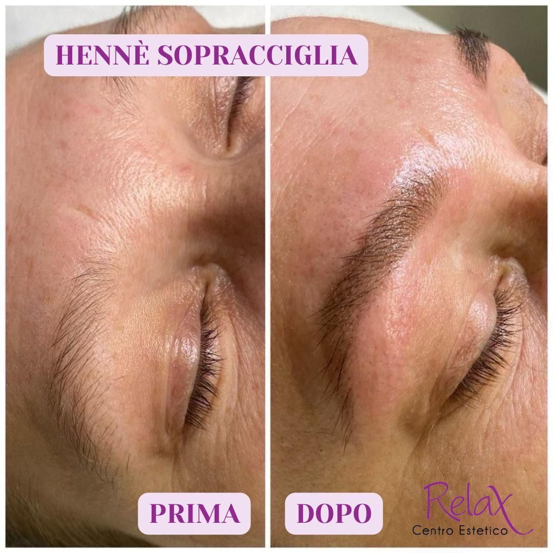 Foto prima e dopo di un trattamento di lifting delle sopracciglia: 