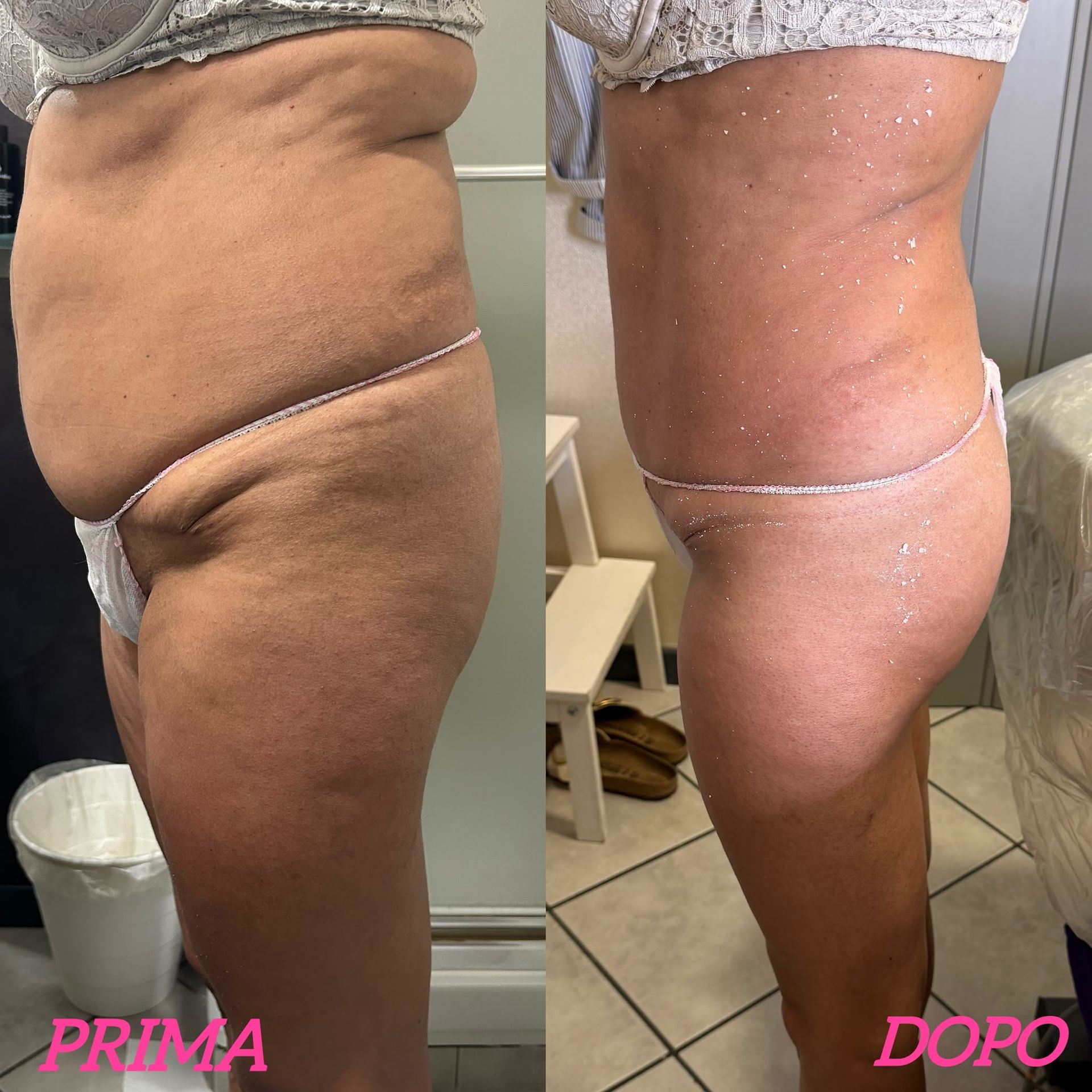 Foto affiancate di addome e coscia prima e dopo, etichettate