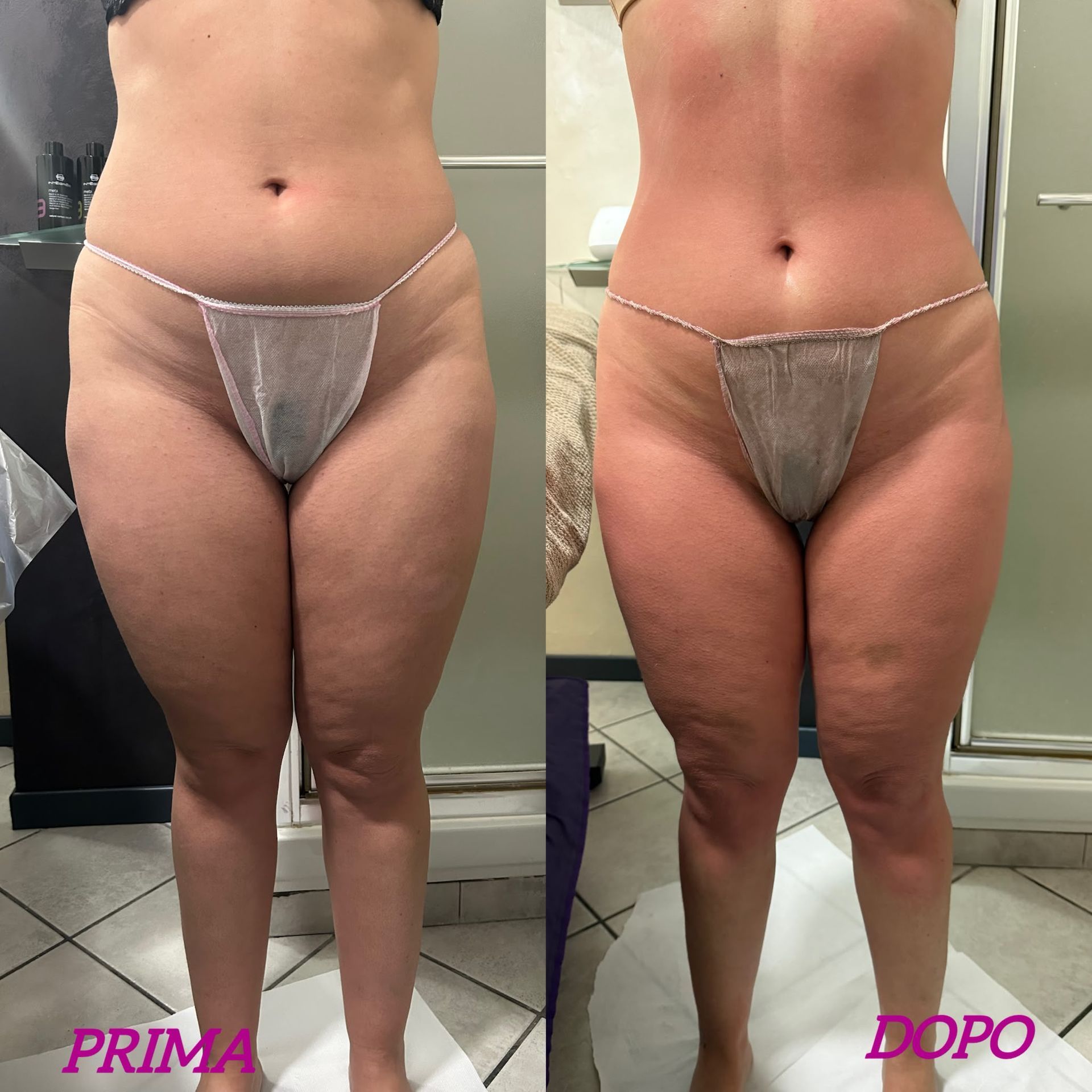 Immagine frontale di una persona in intimo prima e dopo, etichettata