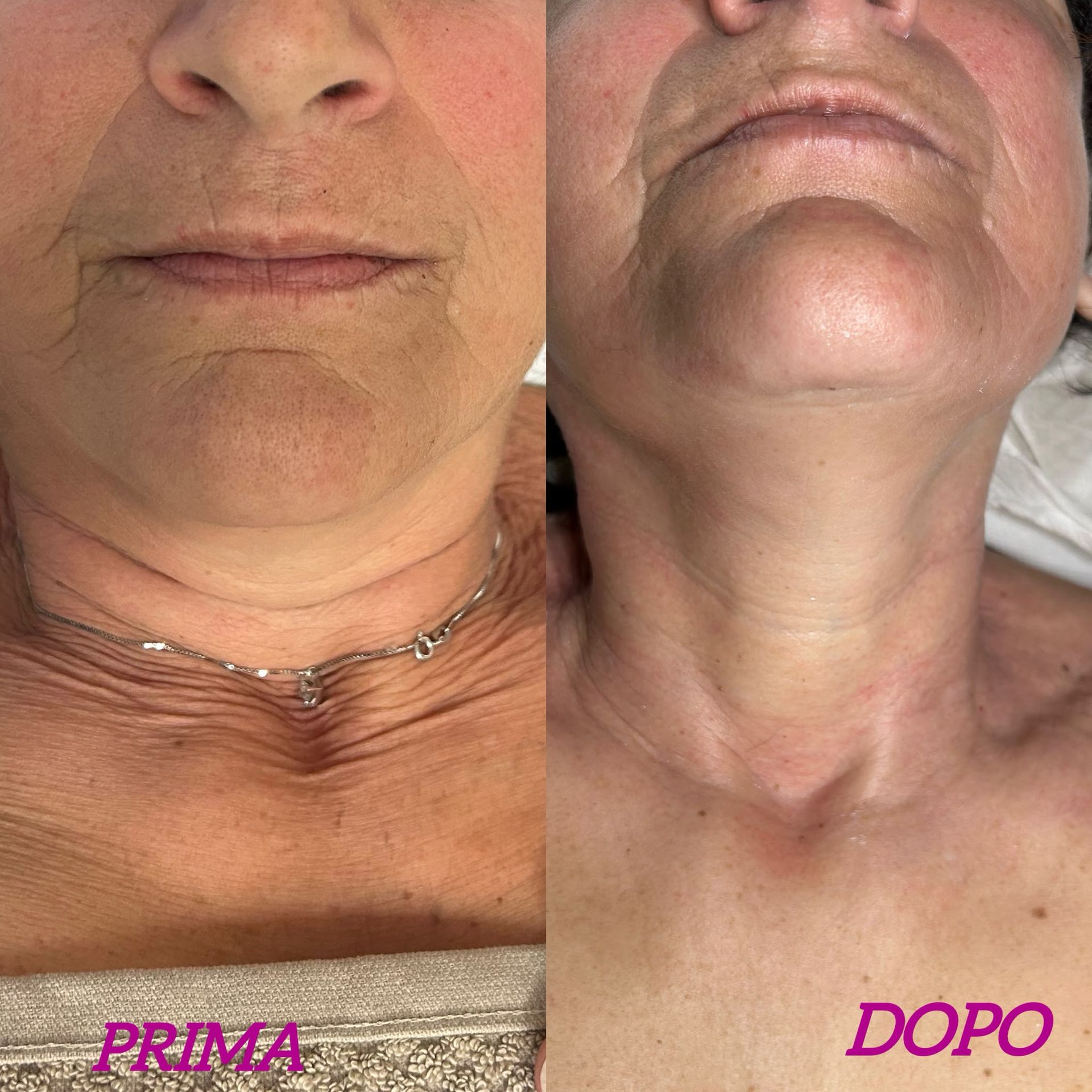 Primo piano affiancato di un collo prima e dopo il trattamento, etichettato
