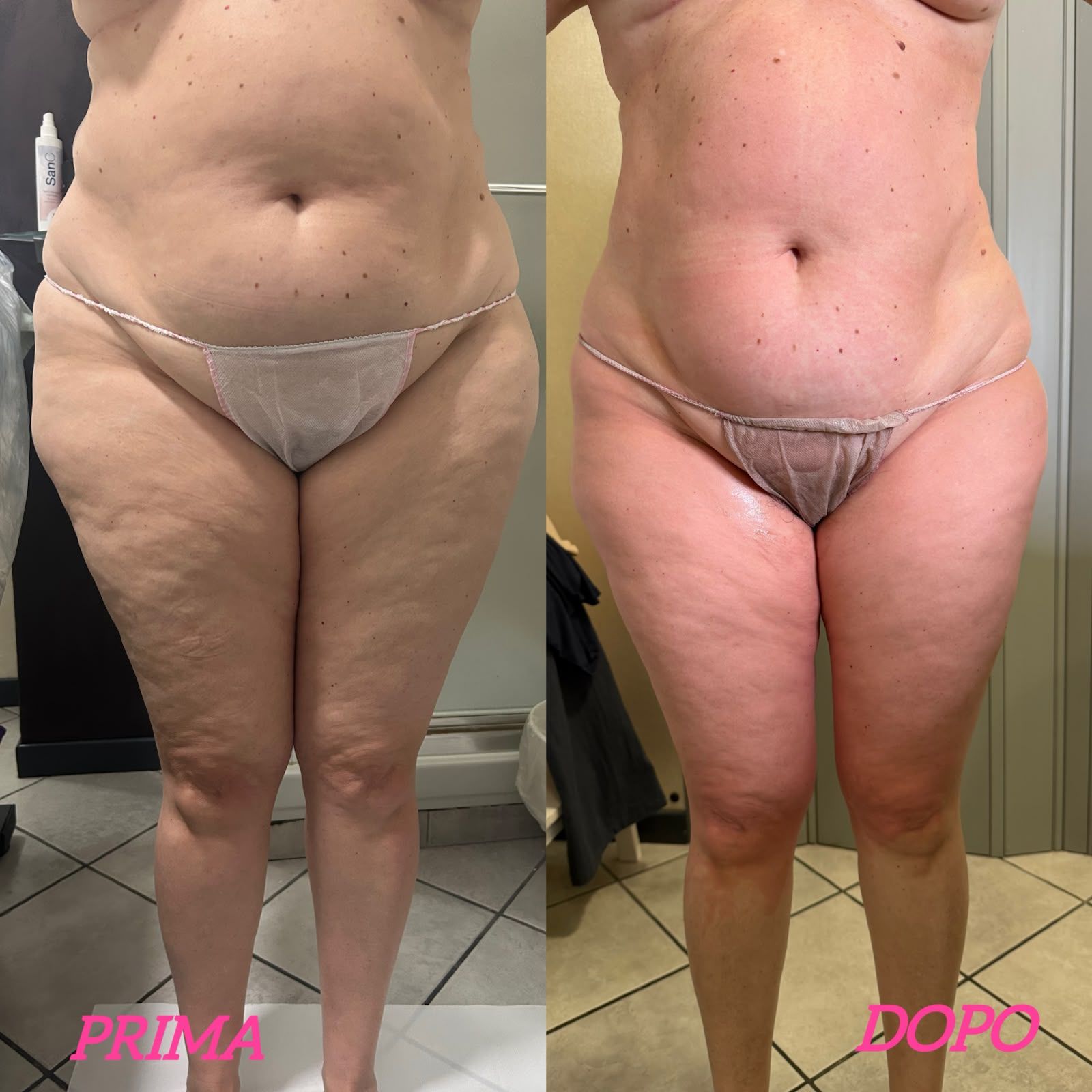 Immagini affiancate del prima e dopo di un busto e di gambe in intimo beige, con le etichette PRIMA e DOPO.