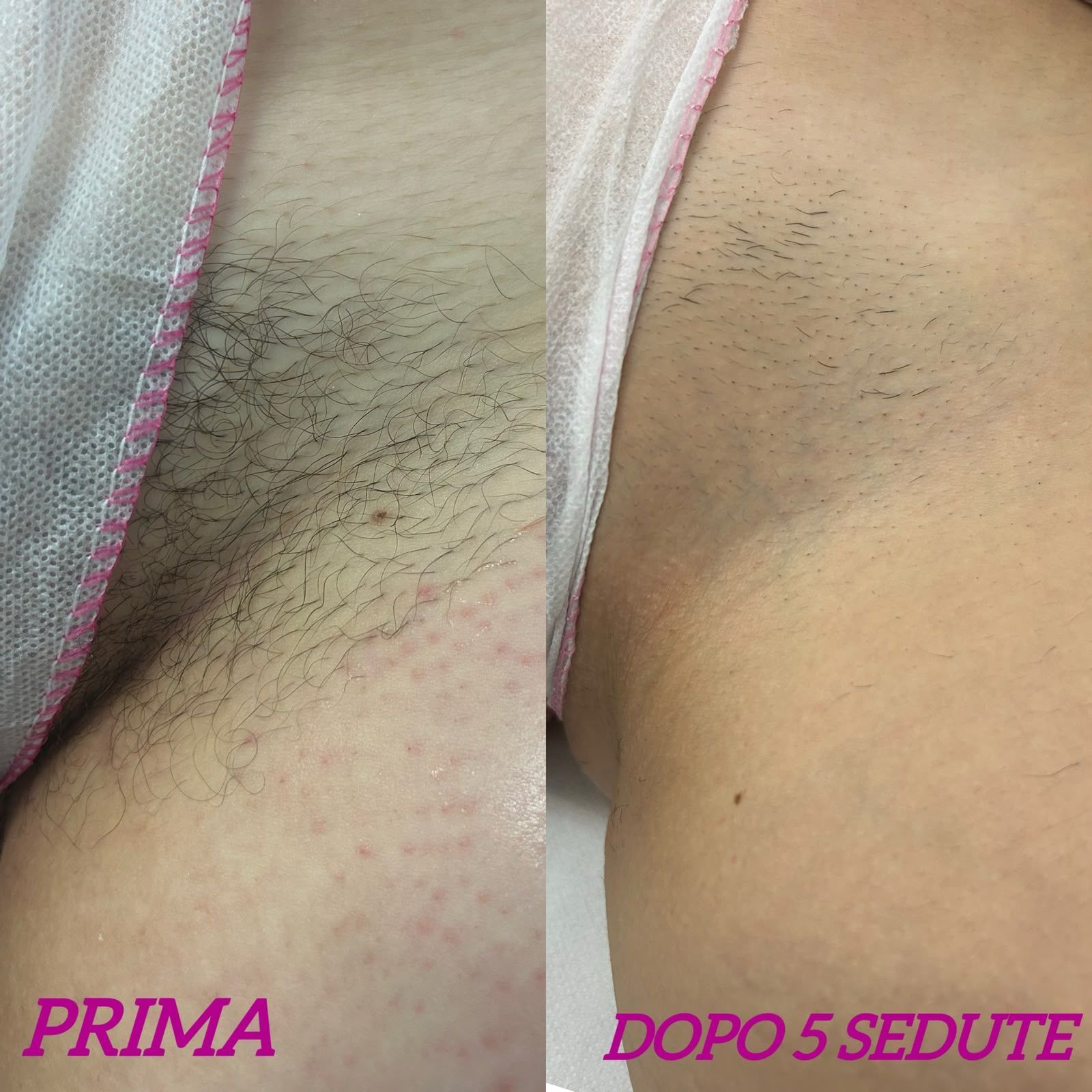 Primo piano prima e dopo della pelle sotto l'ascella, etichettata