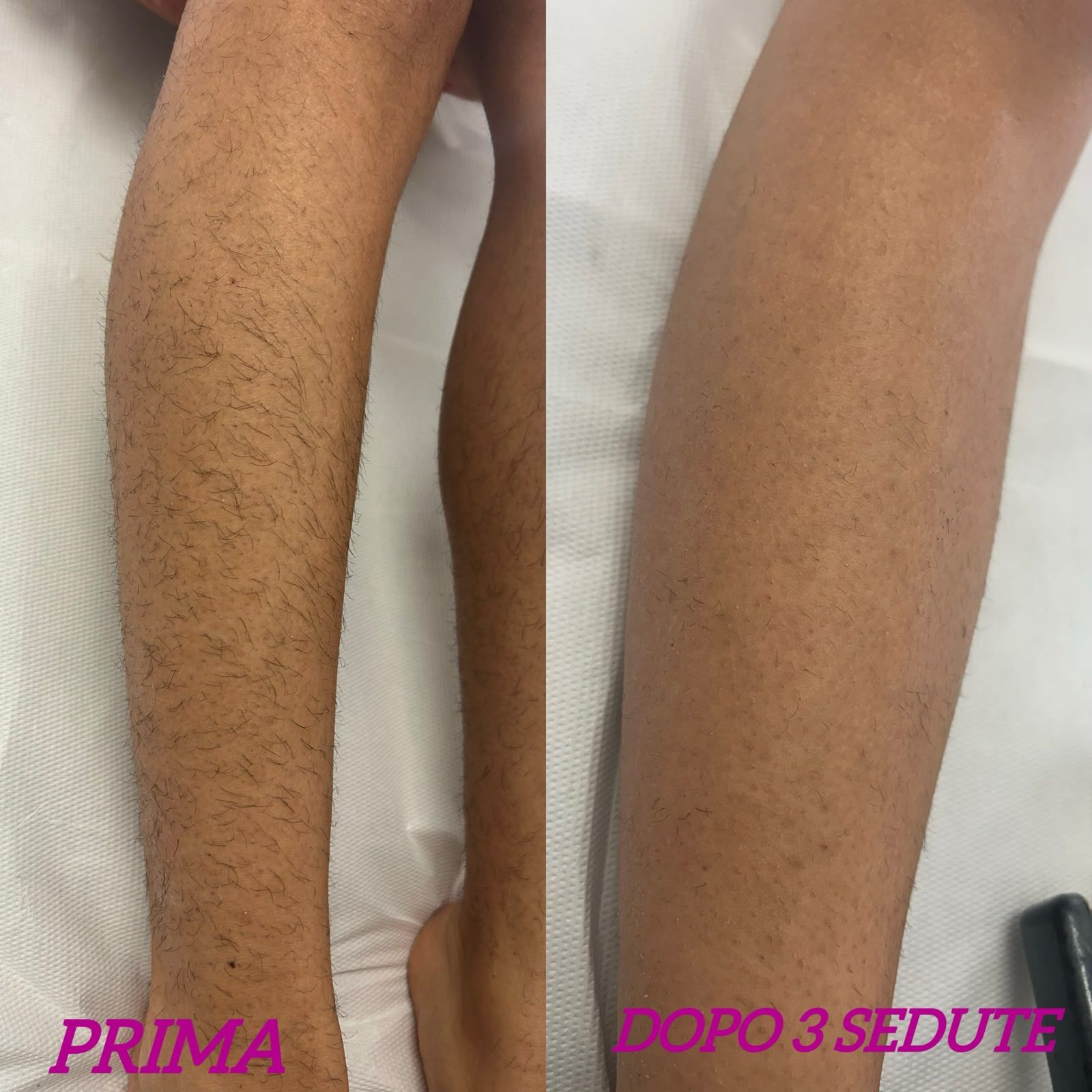 Primo piano affiancato delle gambe prima e dopo 3 sedute di trattamento, che mostra la pelle più liscia sulla gamba destra.