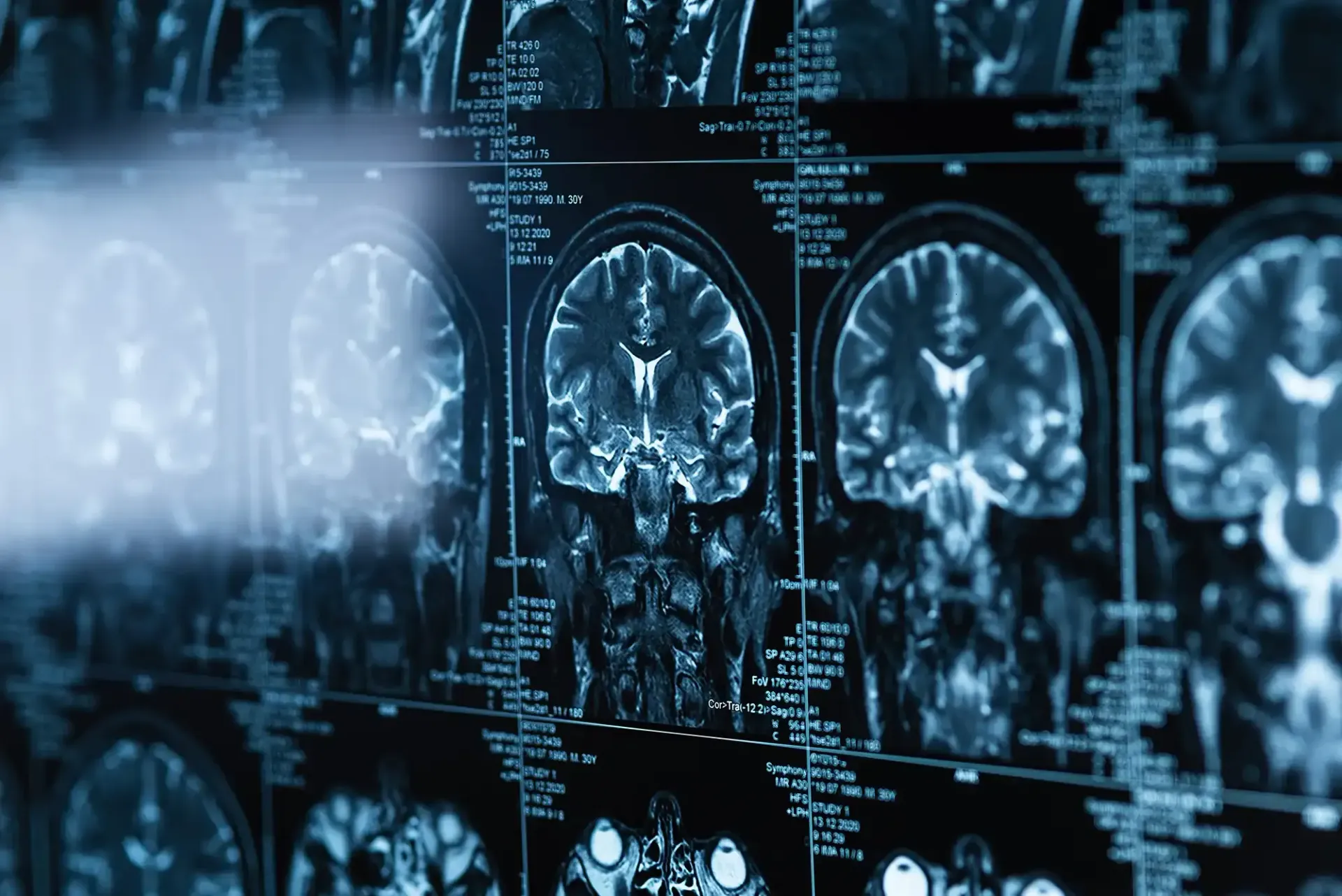 Blue-toned brain scan images displayed on multiple medical monitors