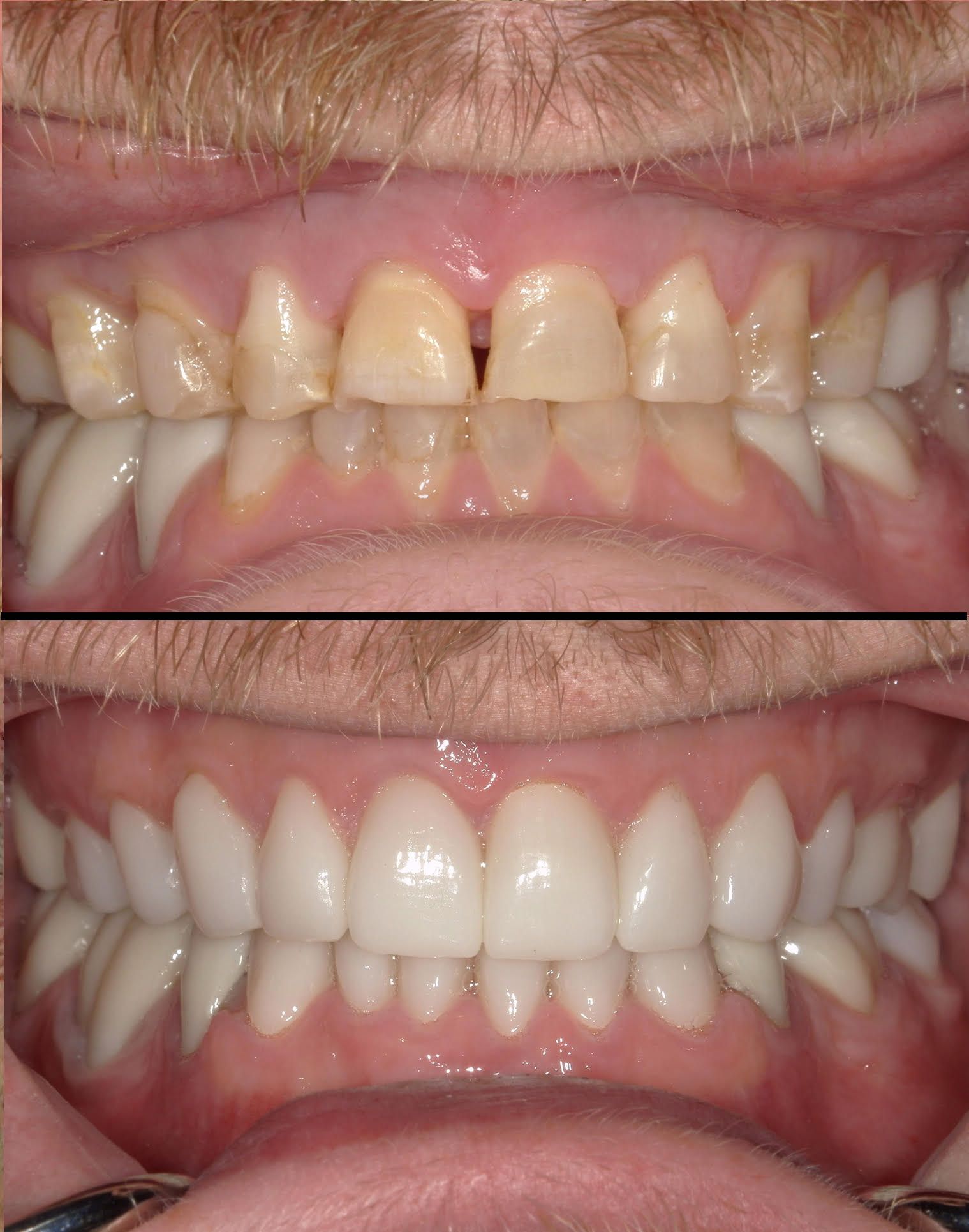 Teeth Before & After Whitening
