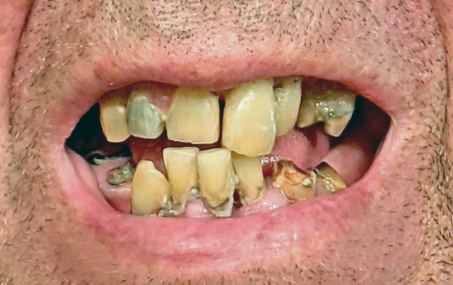 Before Dental Veneers or Crowns

