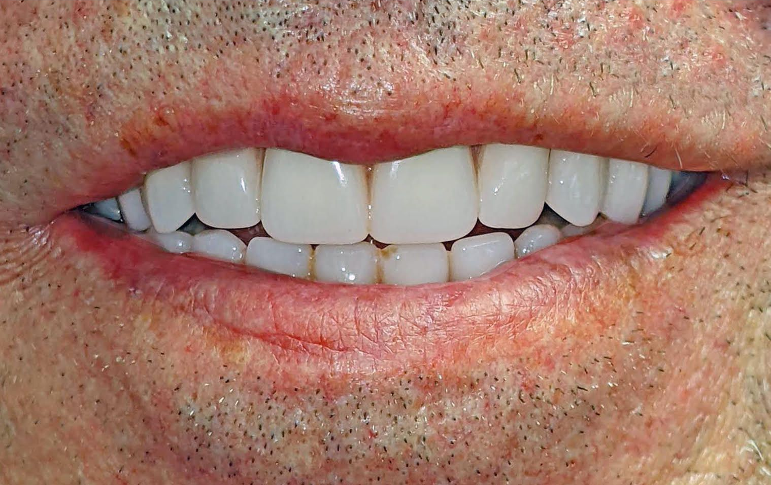 After White Dental Veneers or Crowns