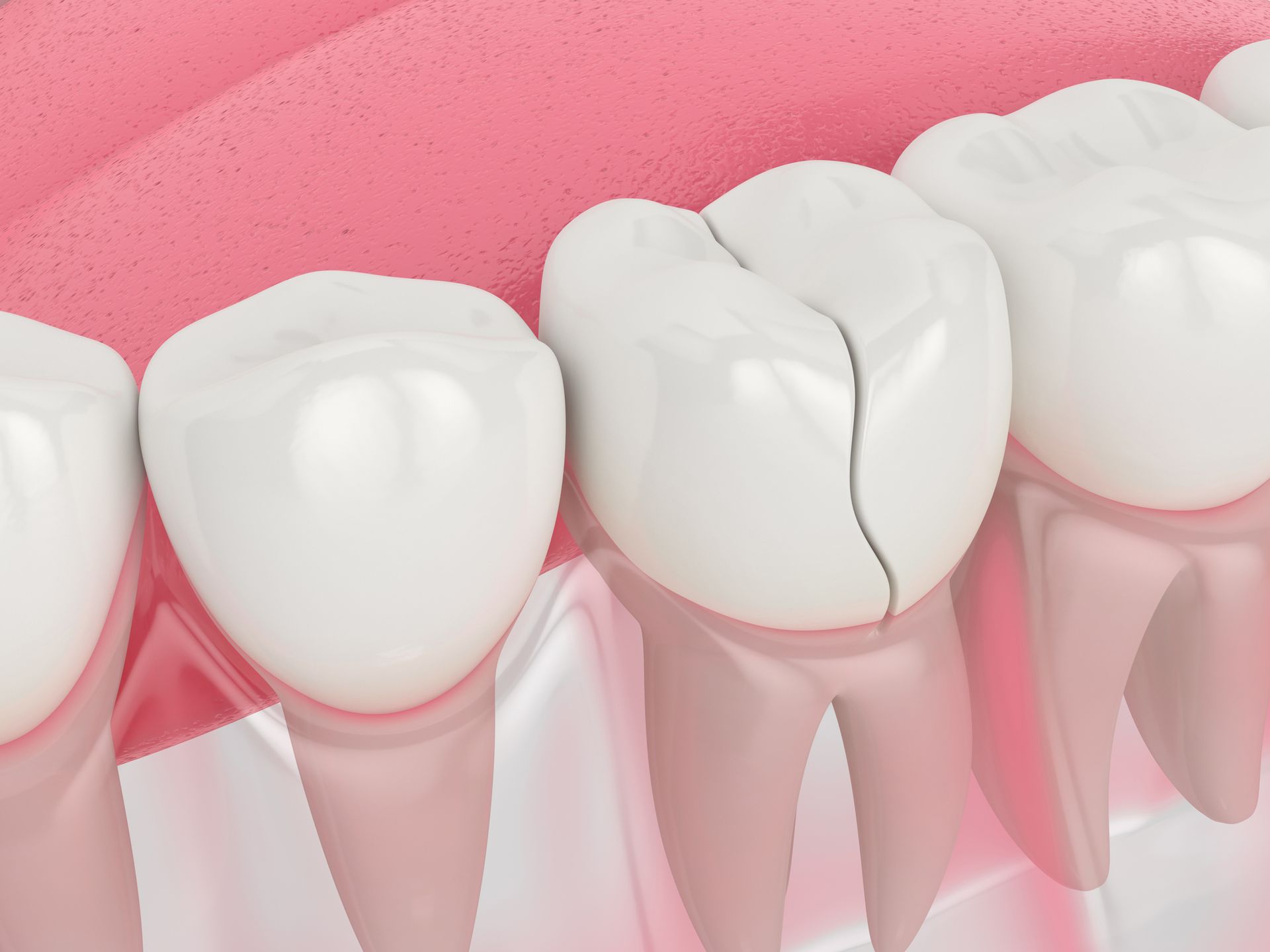 Immediate Care for Chipped, Cracked, or Knocked Out Teeth
