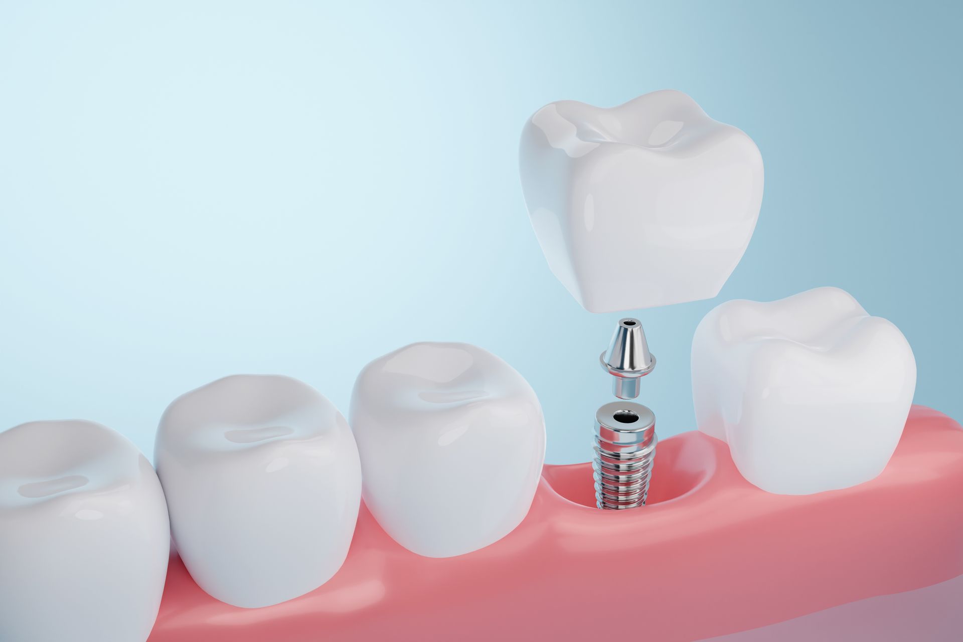 Dental Implants for Permanent Tooth Replacement
