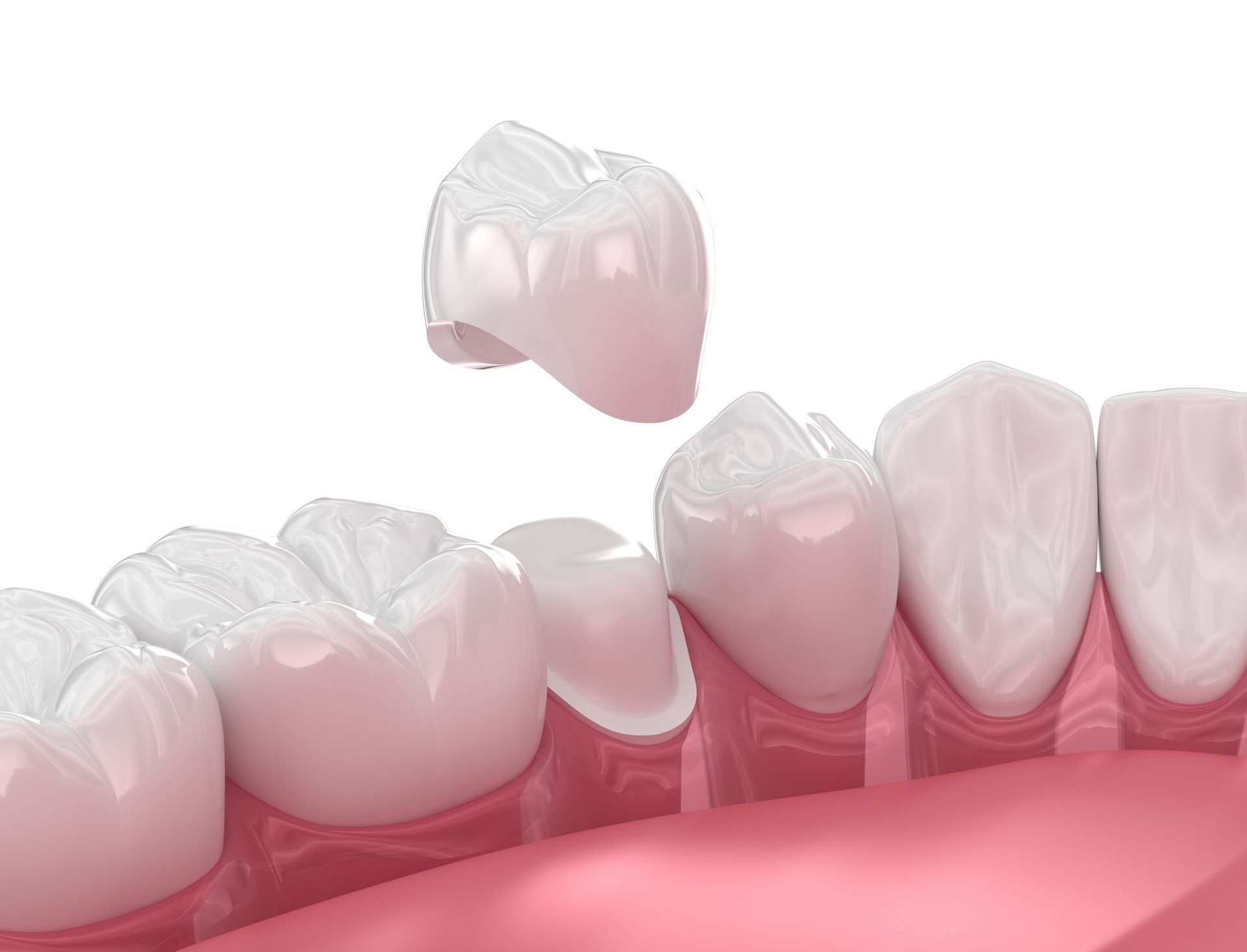 Orthodontic Alignment
