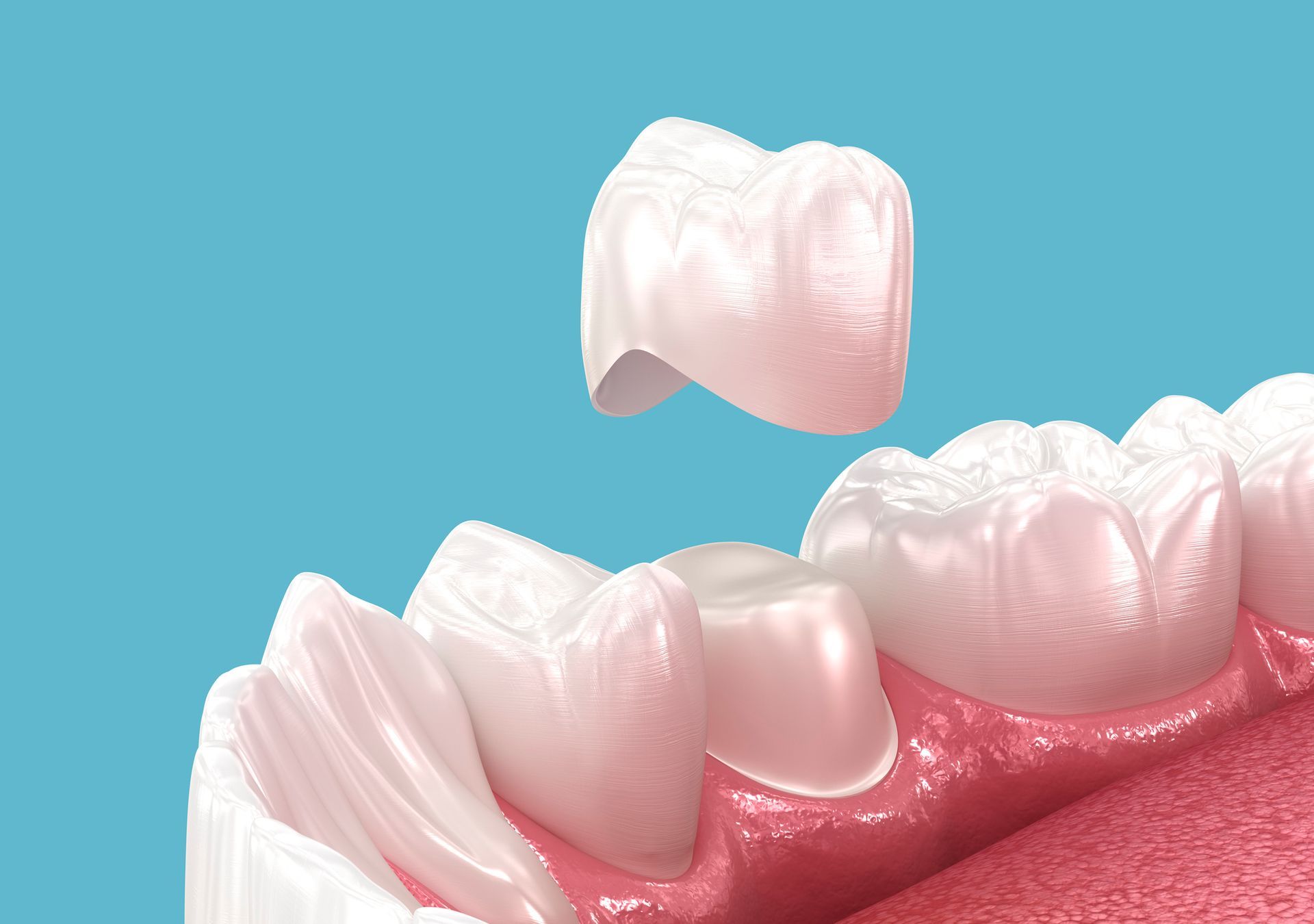 Crowns & Bridgework for Extensive Repair
