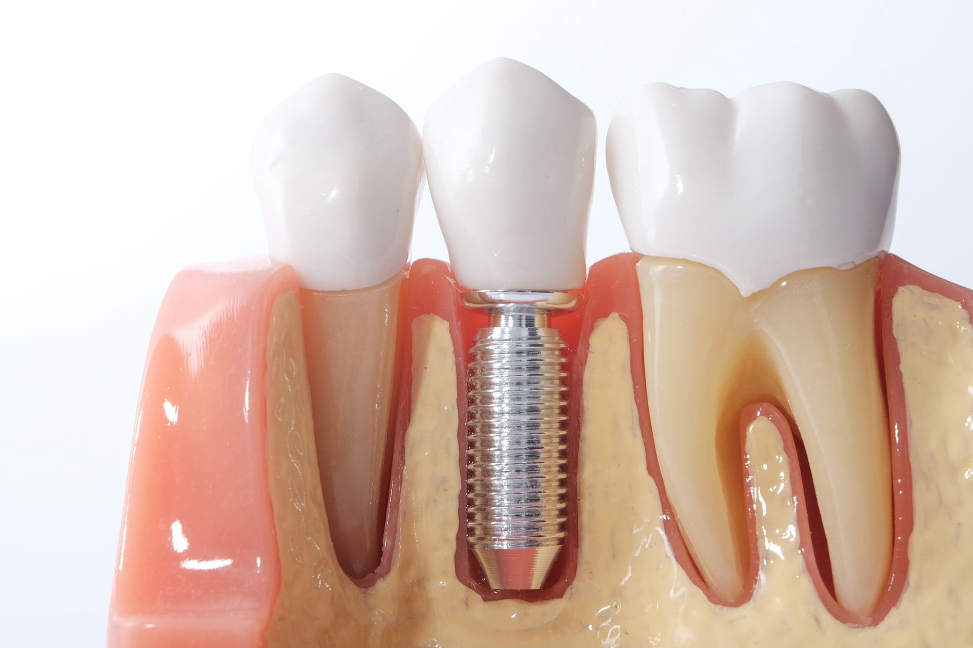 Dental implant with white crown in pink gums, shown beside natural teeth