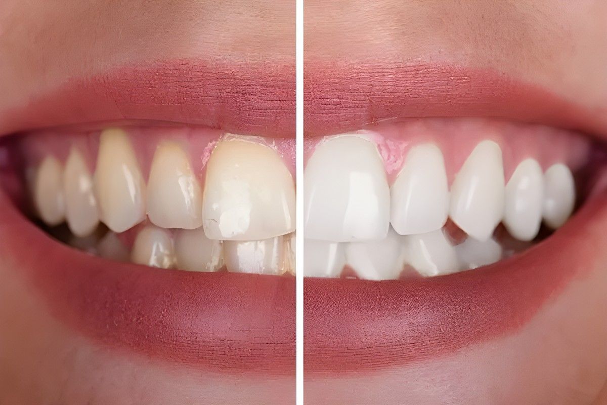 A Before and After Photo of a Woman's Teeth — Jaw Gear Dental Prosthetics in Bowral, NSW