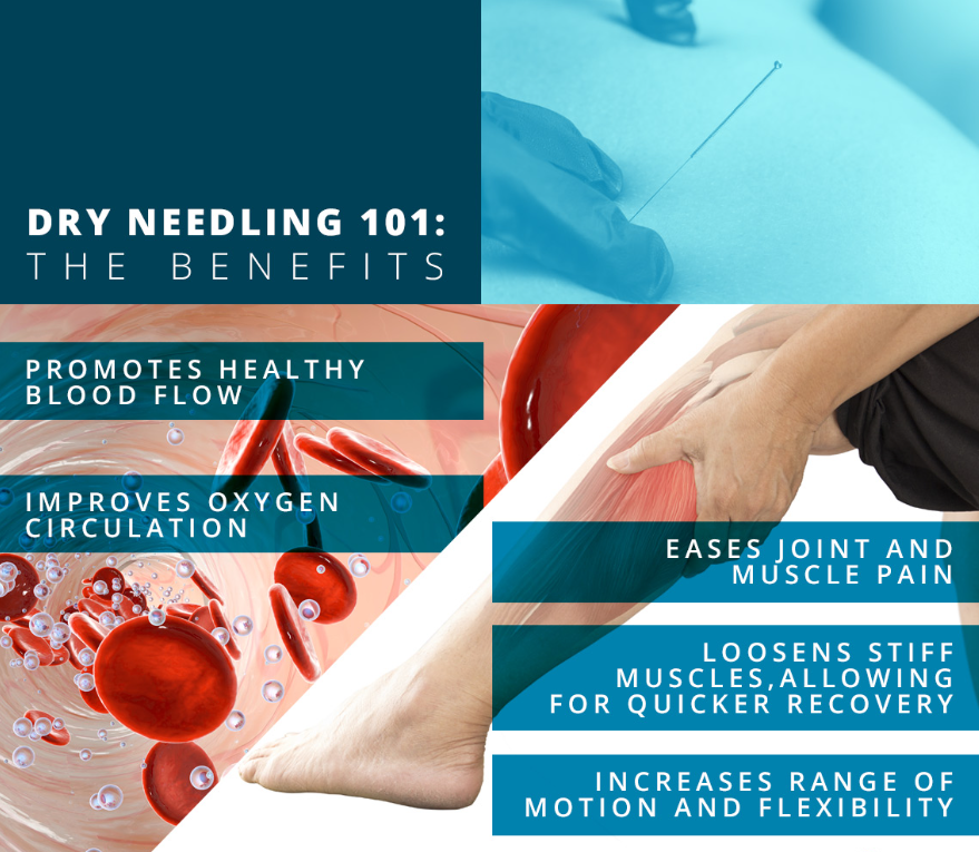 What Injuries Can Dry Needling Treat?