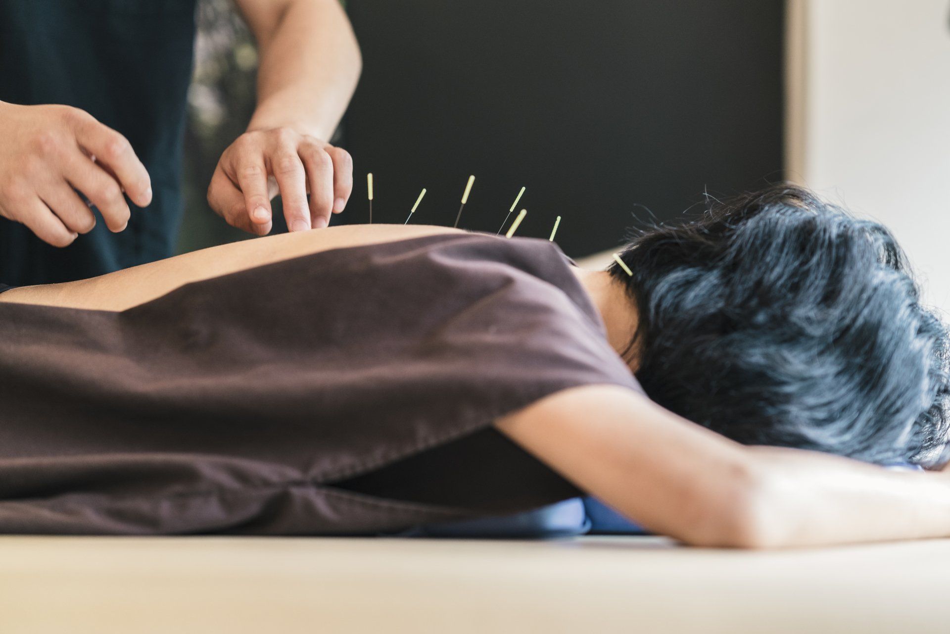 Patient receiving acupuncture therapy at our chiropractor clinic in omaha nebraska