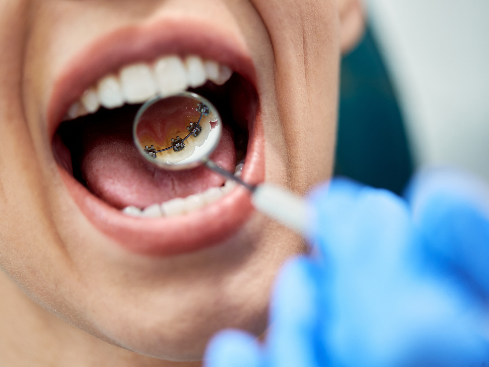 Ortodonzia Linguale Sistemica Fissa Studio Dentistico Maceroni