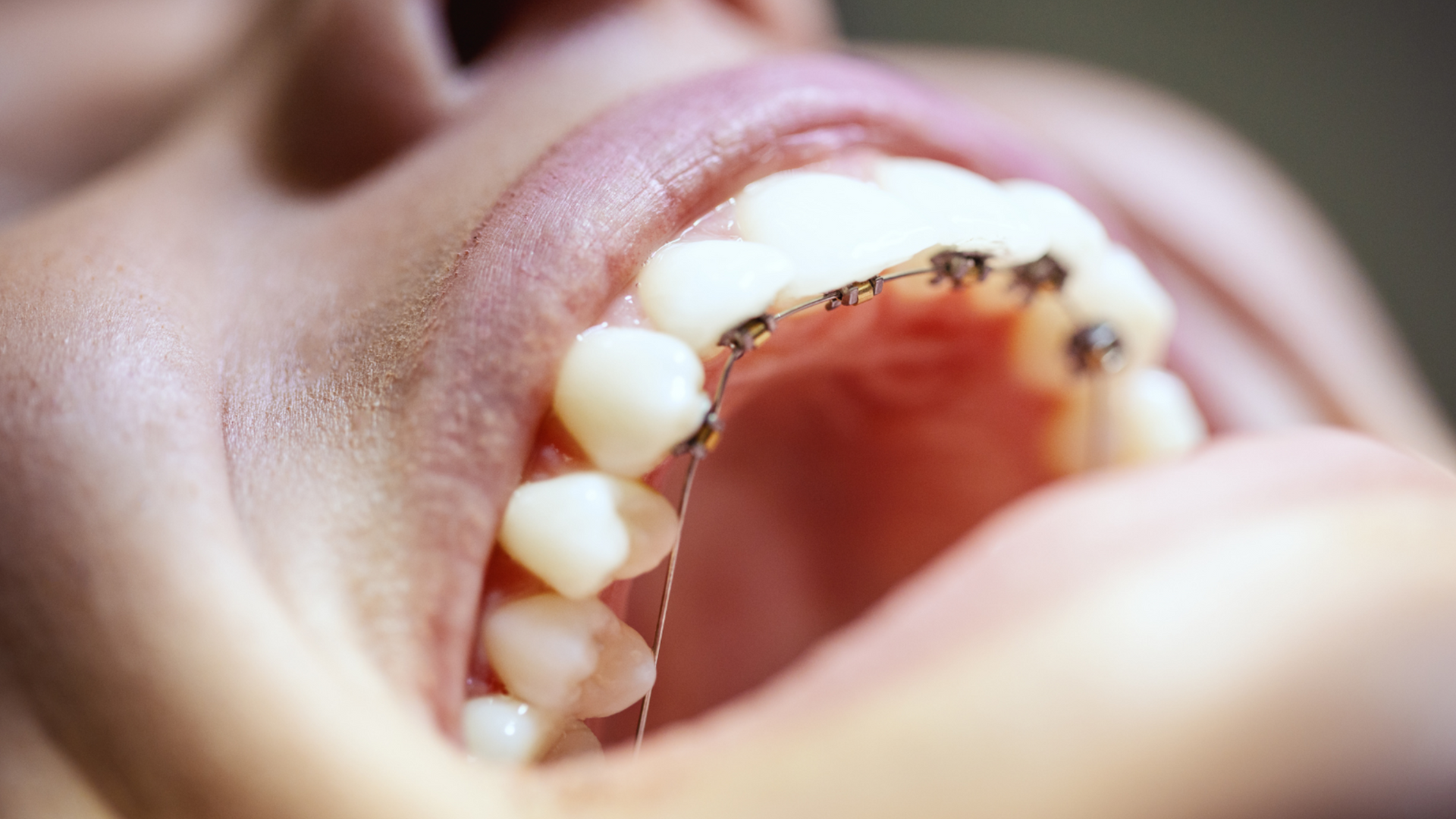 Ortodonzia Linguale Sistemica Fissa Studio Dentistico Maceroni