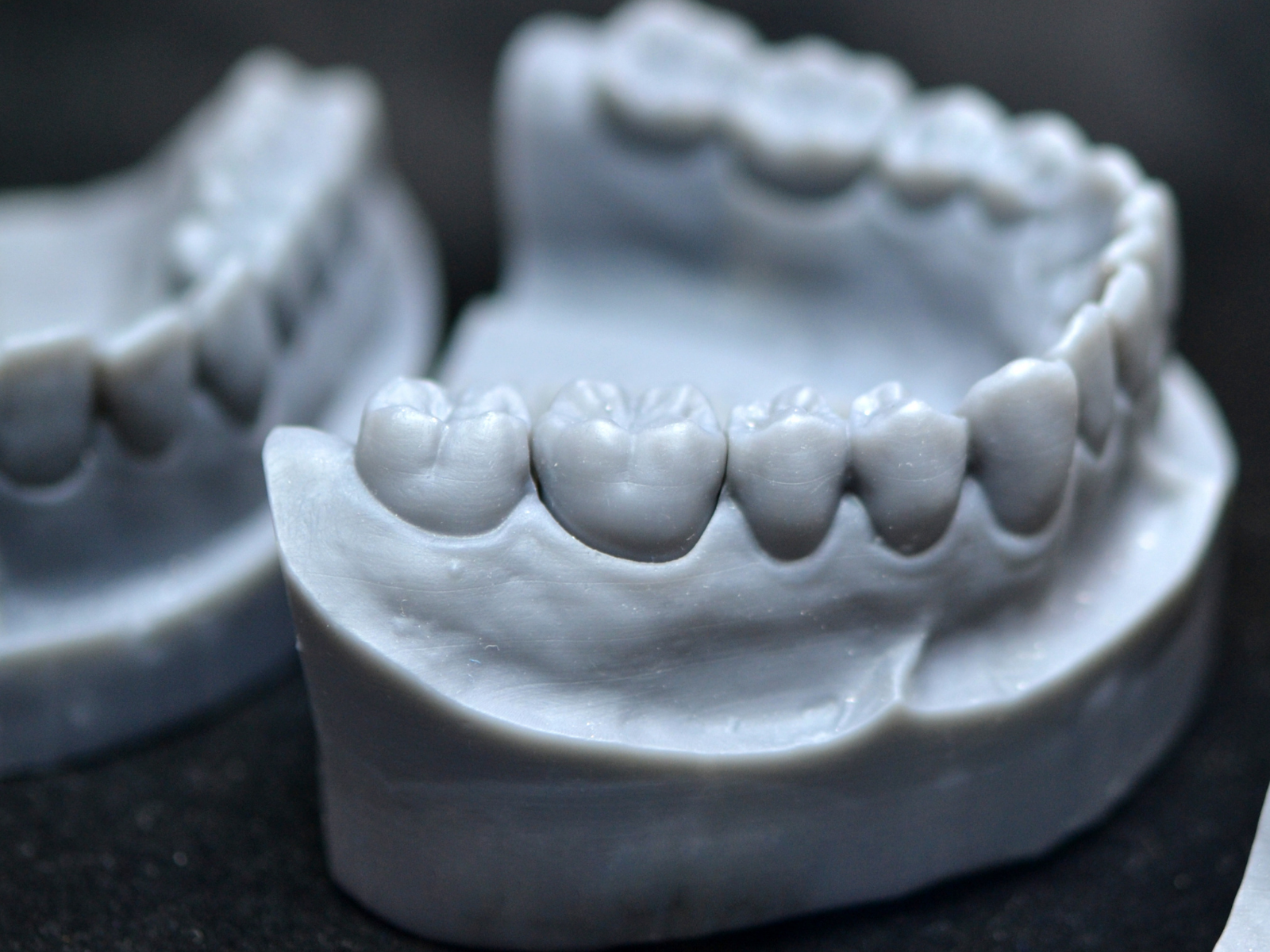 Overdenture scopri quali sono  vantaggi e quando  indicata