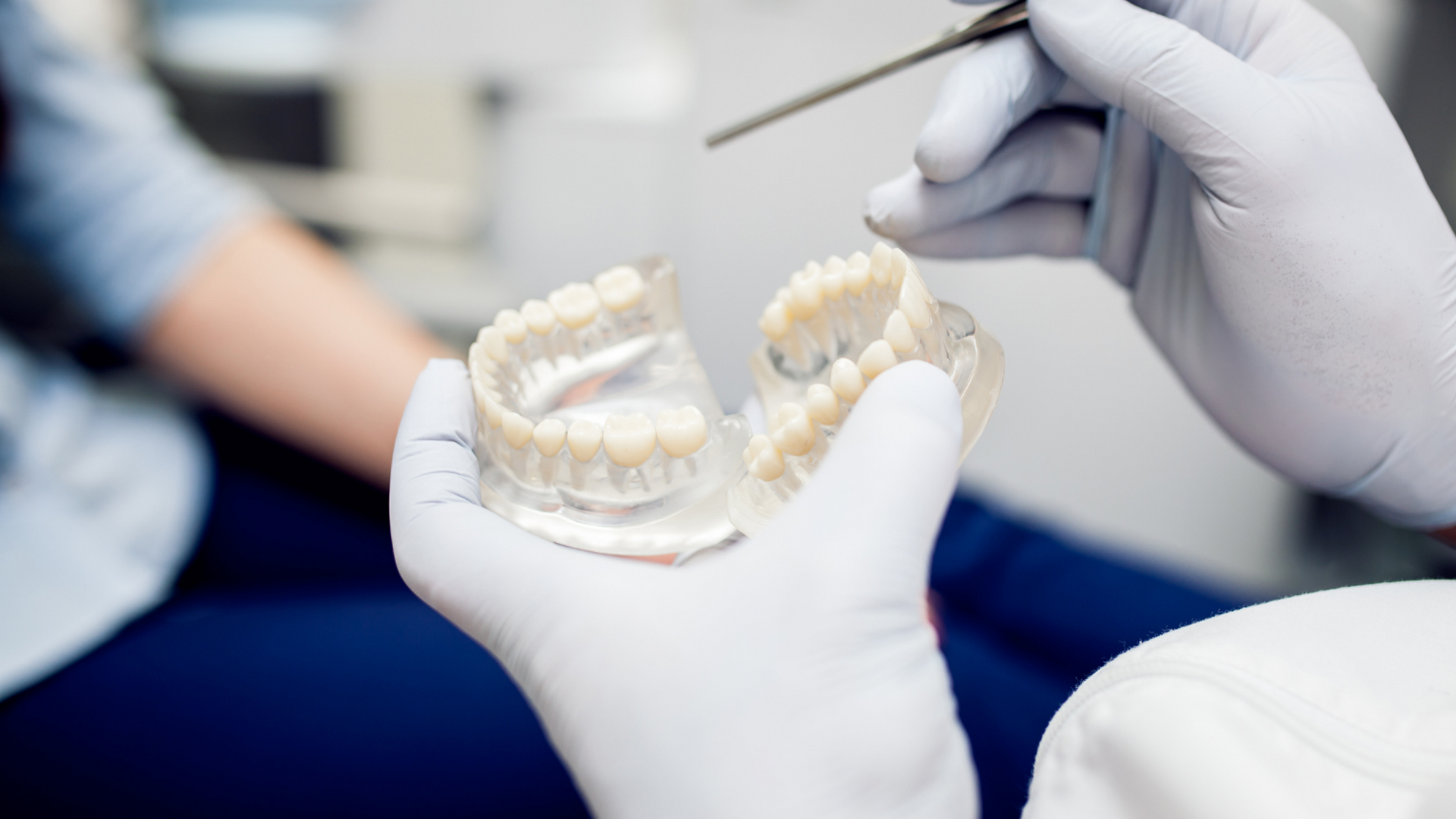 Overdenture, come funziona e quando può essere utile