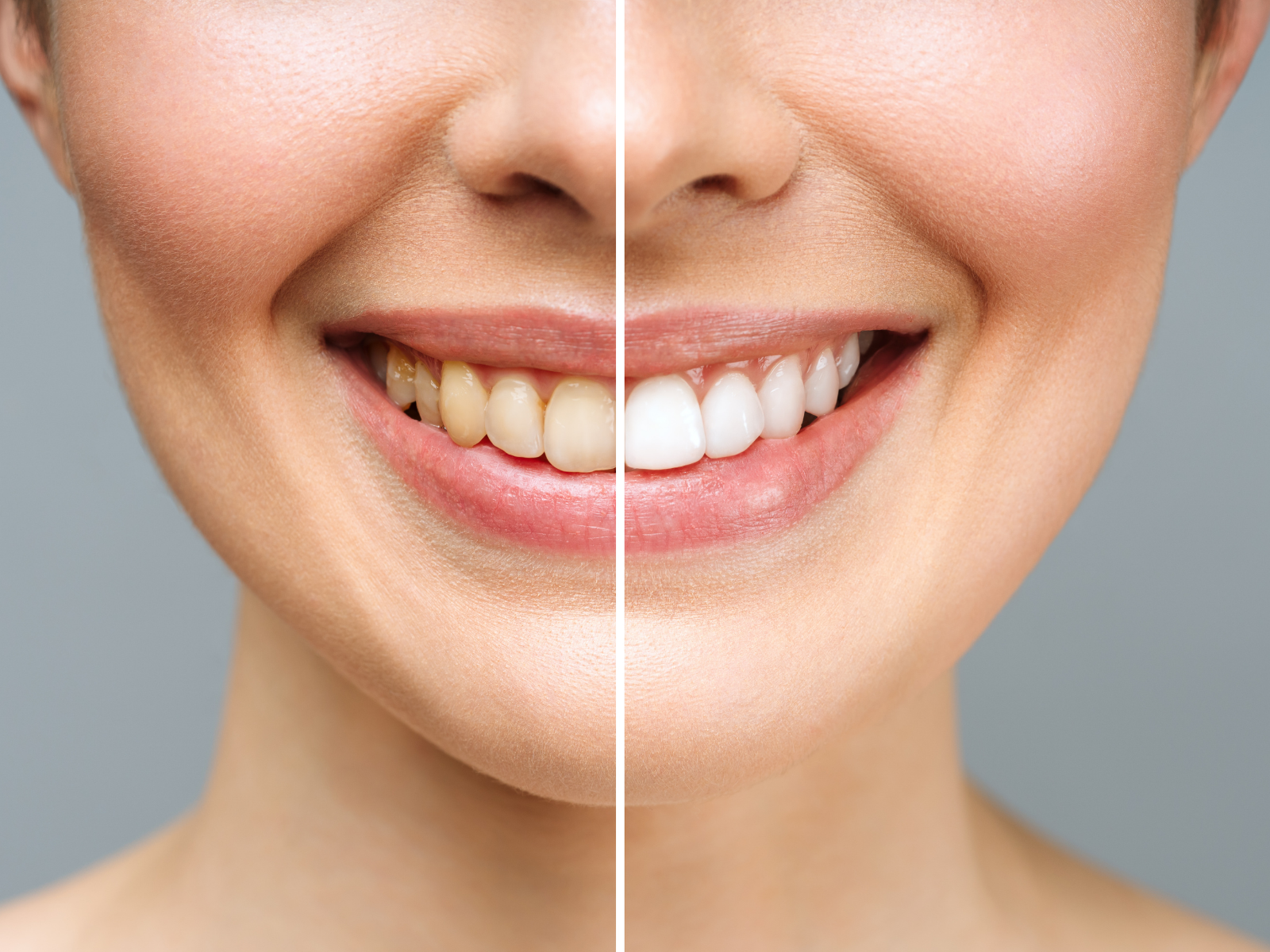 Sbiancamento Dentale Studio Dentistico Maceroni