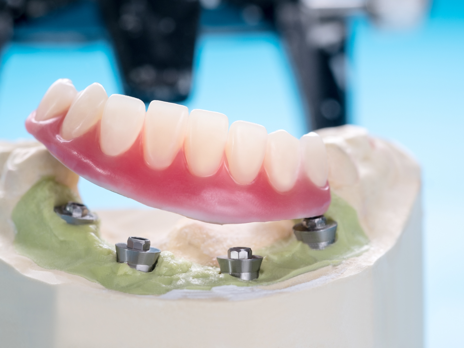 Studio Dentistico Maceroni protesi in zirconia e overdenture