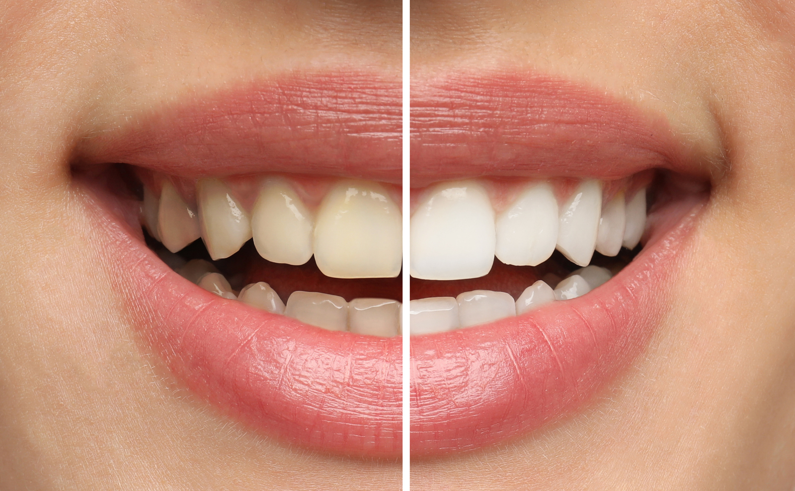 Sbiancamento Dentale Studio Dentistico Maceroni