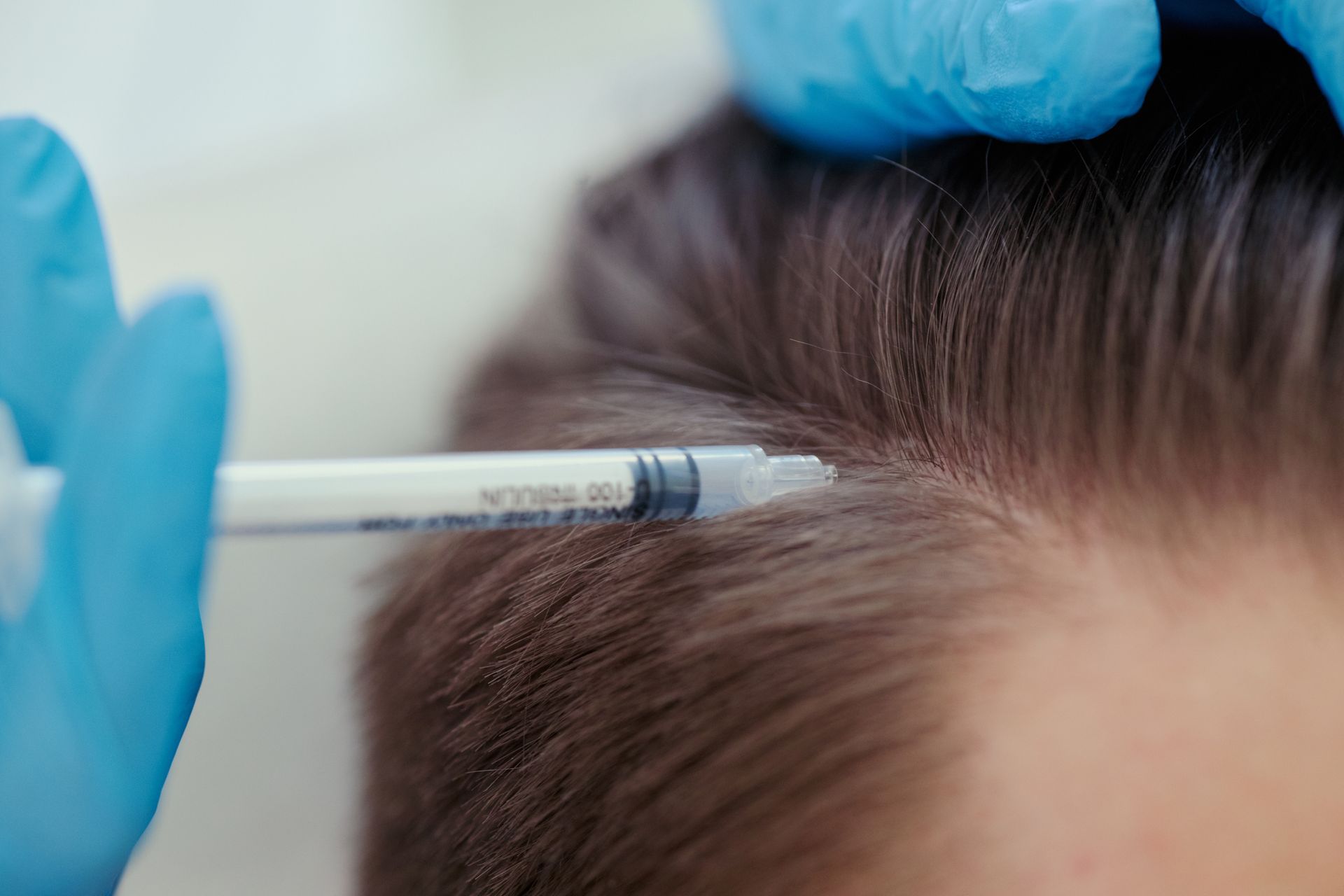 Clinician administering a scalp injection to an adult patient during a hair restoration treatment.