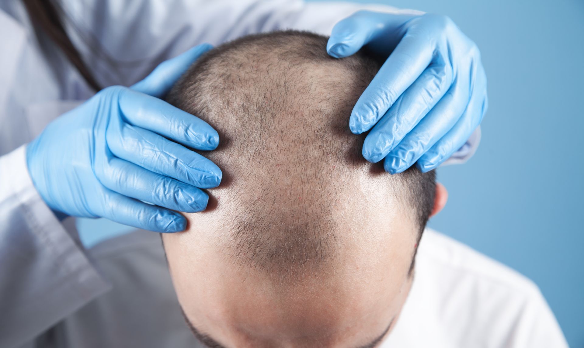 Specialist evaluating hair loss for customized replacement treatment. Specialist evaluating hair loss for customized replacement treatment.