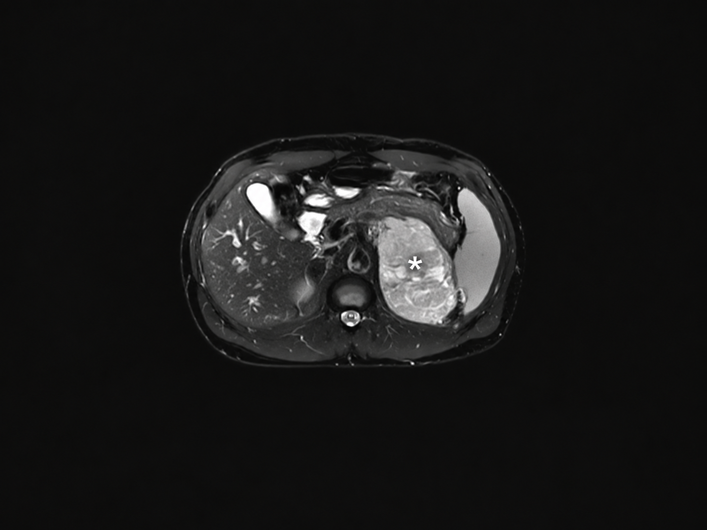 Ressonância magnética com massa na adrenal esquerda sugestiva de malignidade.