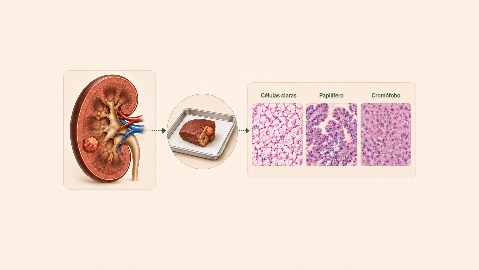 Tipos de câncer de rim: células claras, papilífero e cromófobo. Peça cirúrgica e histologia.