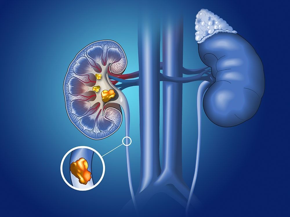 Ilustração dos rins e ureteres, mostrando um rim com cálculos e um detalhe de um cálculo renal.