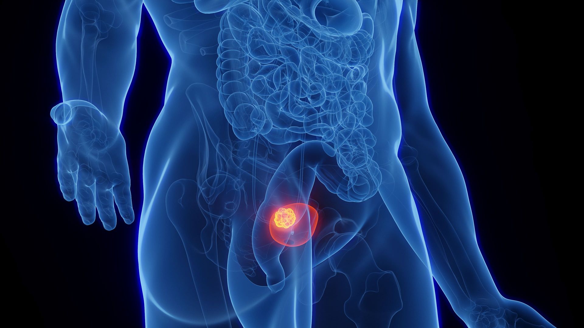 Ilustração médica azul de uma pélvis humana com uma mancha de dor vermelho-alaranjada brilhante na região do quadril.