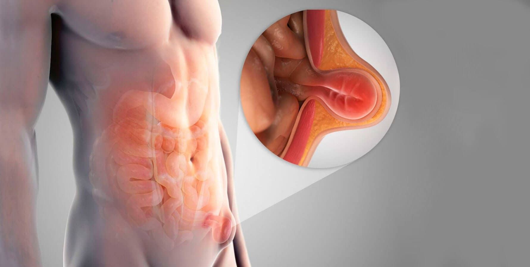 Vista lateral de um torso com a região lombar avermelhada e inflamada, com detalhe mostrando uma hérnia de disco inchada.