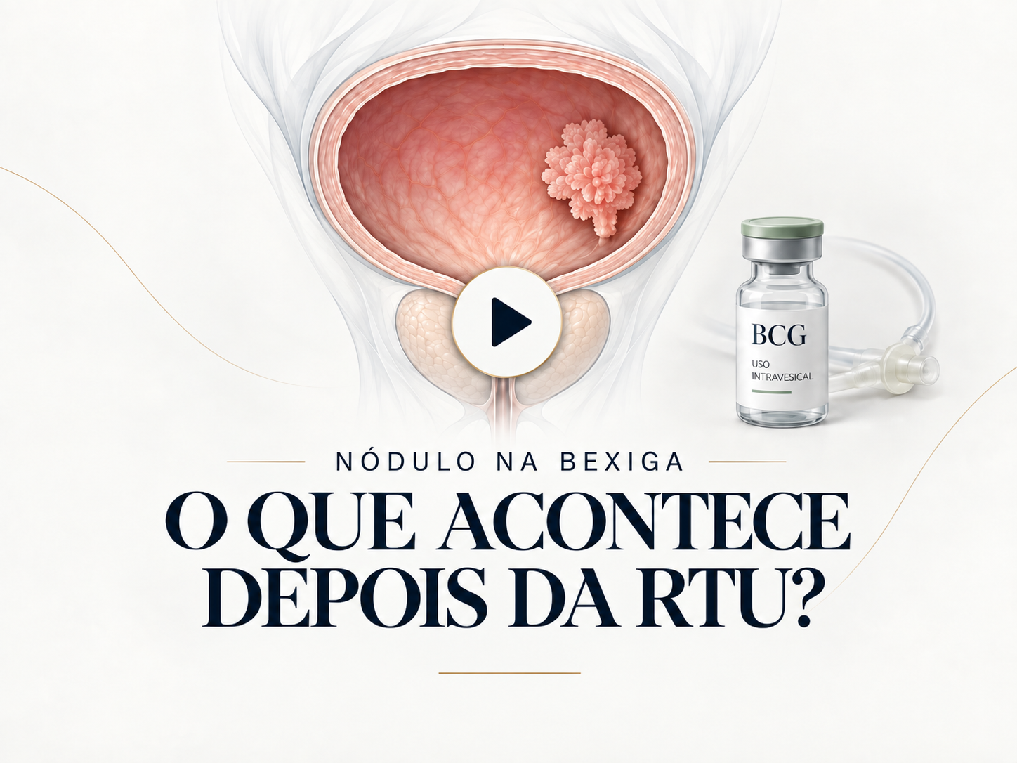 Ilustração médica de bexiga com nódulo, frasco de remédio e texto “O que acontece depois da RTU?”