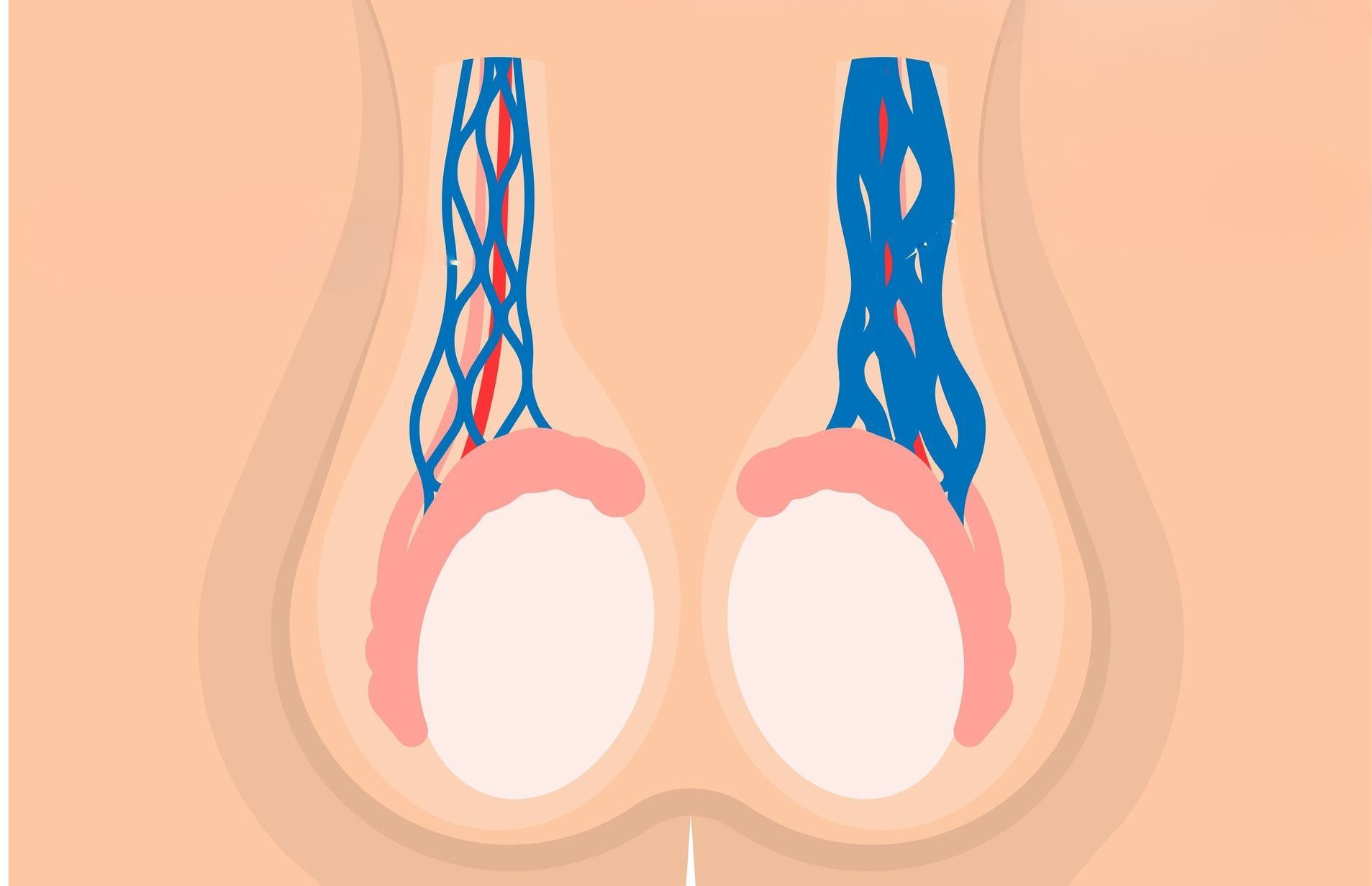 Diagrama dos testículos com veias azuis, mostrando inchaço e torção ao redor do cordão espermático.