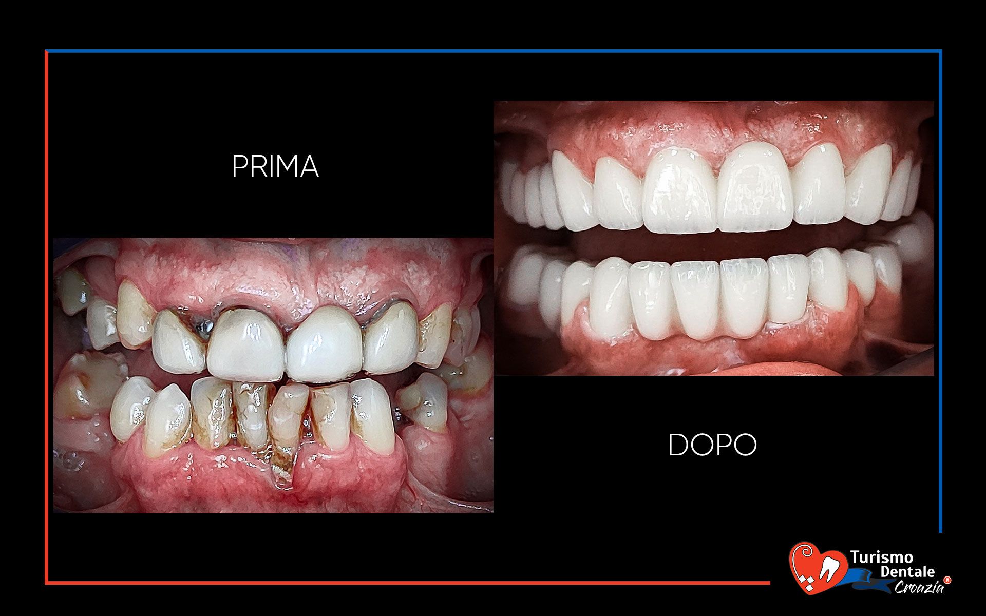 Corone dentali prima e dopo esempio #1