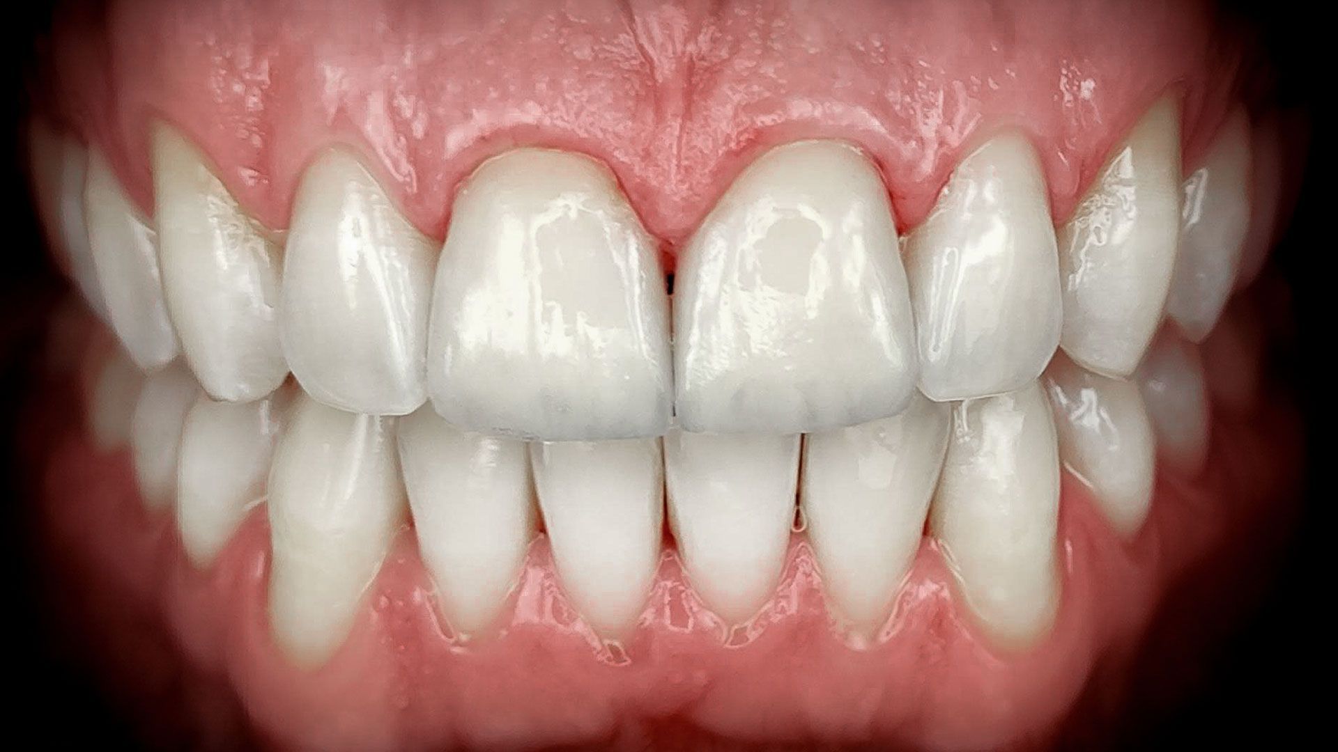 Primo piano di una bocca sorridente che mostra denti bianchi e gengive rosa