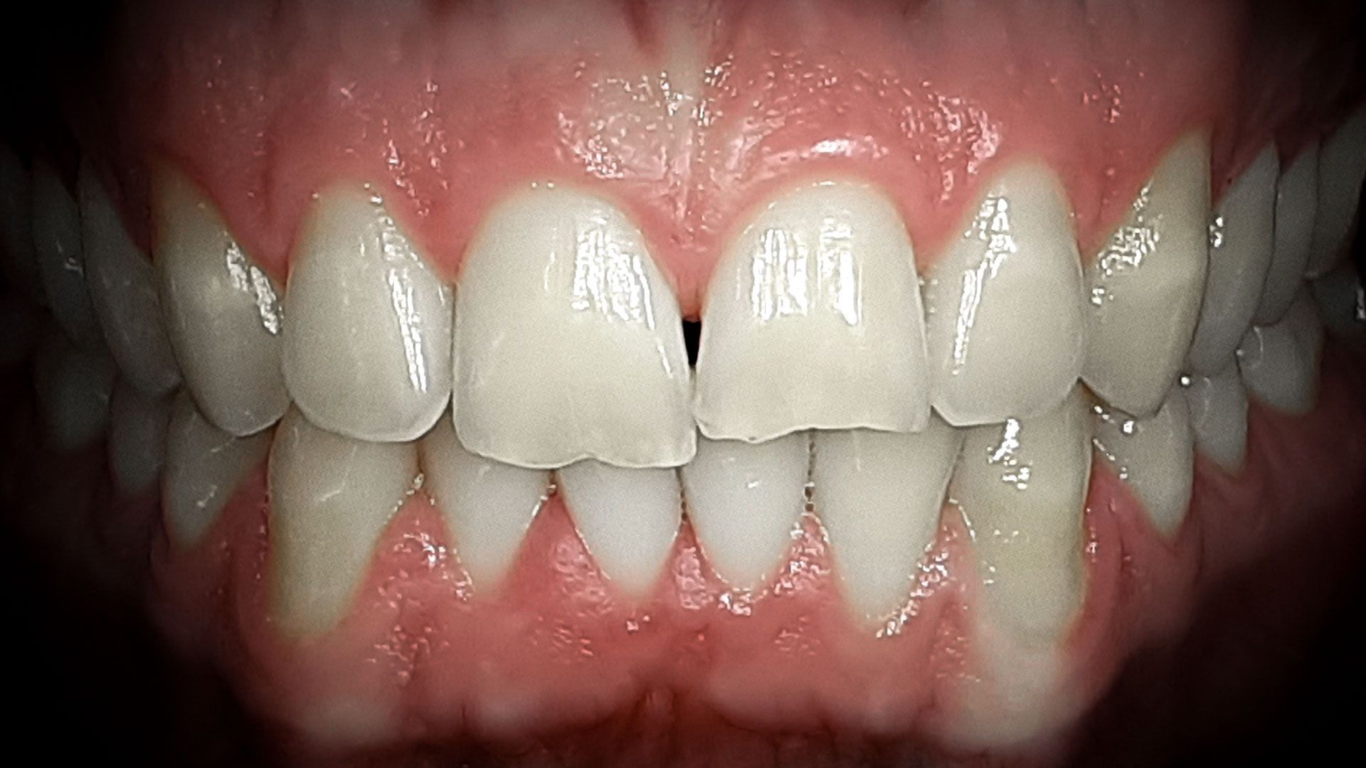 Primo piano di una bocca umana che mostra denti bianchi e gengive rosa, con i denti incisivi ben chiusi.